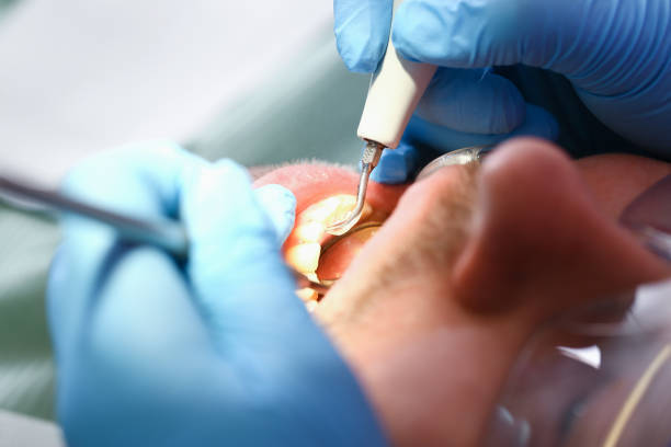 Best Emergency Dentist for Knocked-Out Tooth in Happy Valley, CA