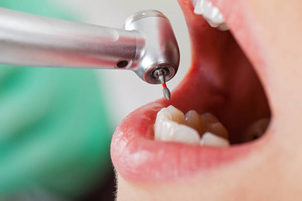 Best Emergency Dentist for Knocked-Out Tooth in Happy Valley, CA